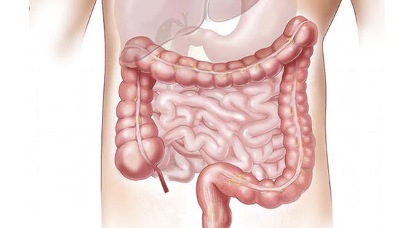 Câncer do Intestino (colorretal)