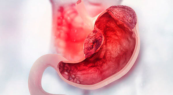 Câncer do Estômago