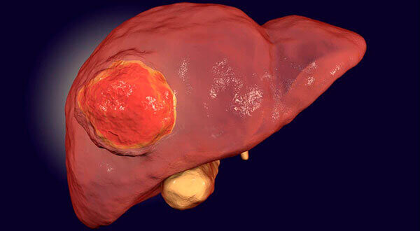 Câncer do Fígado