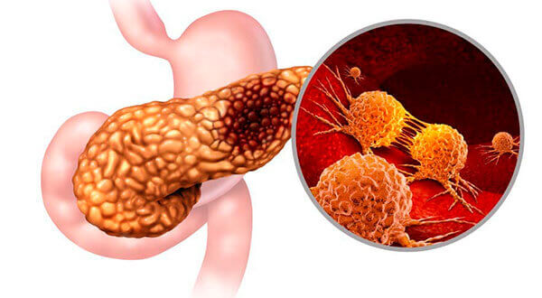 Câncer do Pâncreas