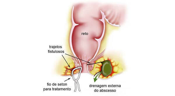 Fístulas e Abscessos Anais