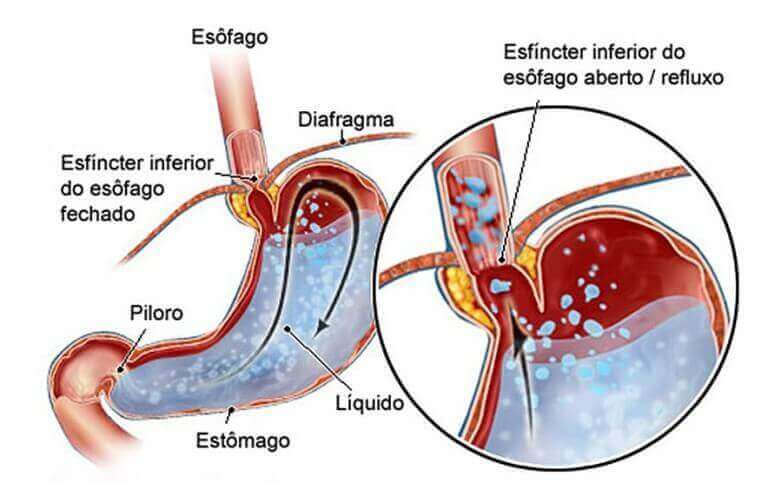 Doença Do Refluxo Gastroesofágico Dr Paulo Pittelli