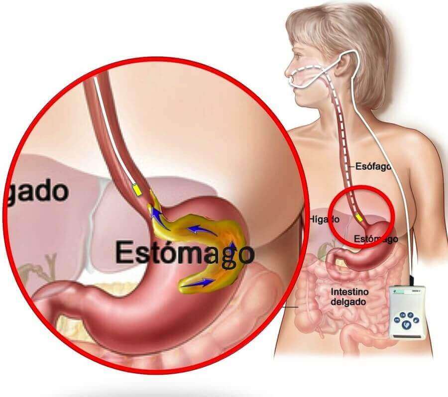 Sintomas atípicos como dor nas costas e no estômago podem indicar