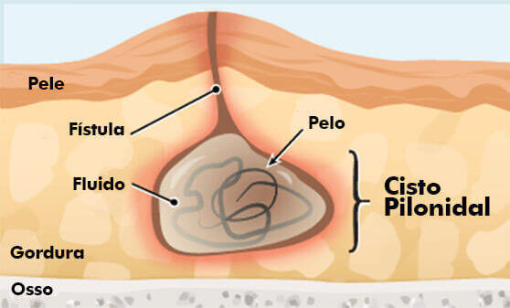 Cisto pilonidal: o que é, sintomas e cirurgia